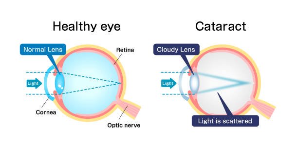 Cataracts